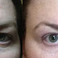 Устранение "гусиных лапок"