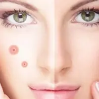 Как избавиться от прыщей и черных точек