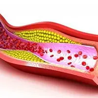 Как снизить плохой холестерин. Часть 1