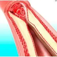 Как снизить плохой холестерин. Часть 2