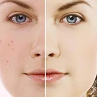 Жирная кожа