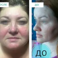 Скульптурно-буккальный массаж лица