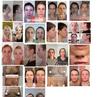 Миофейс: органическое омоложение лица