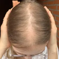 Волосы: выпадения и алопеции