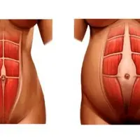 Коррекция диастаза, восстановление функции мышц тазового дна