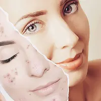 Дерматологический подход в лечении акне