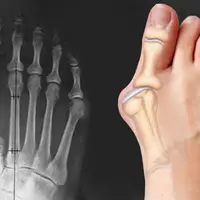 Массаж при вальгусной деформации стопы