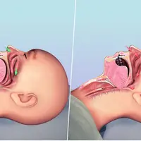 Облегчение апноэ во сне Powerful Plus + 11x