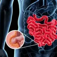 Лечение грыжи