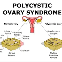 Исцеление синдрома поликистозных яичников