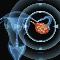 Восстановление яичников