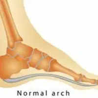 Исцеление плоскостопий