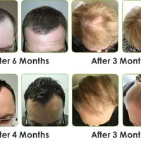 Программа восстановления роста волос. Три продвинутые версии