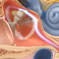 Дисфункция Евстахиевой трубы Powerful Plus +11x