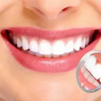 Удаление зубного налета и зубного камня