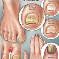 Удаление грибка ногтей