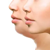 Удаление двойного подбородка