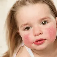 Атопический дерматит у взрослых и детей