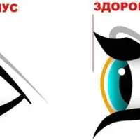 Убираем кератоконус. Возвращаем нормальную форму глаз