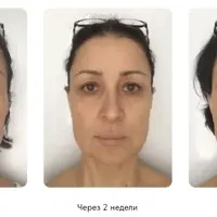 Мини-комплексы для проработки отдельных зон лица и решения локальных возрастных проблем