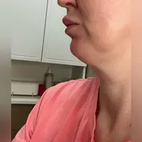 Новое лицо. Восстановление прикуса и симметрии