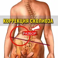 Сколиоз-off
