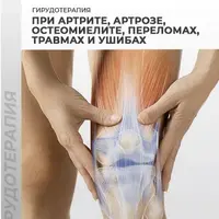 Гирудотерапия при артрите, артрозе, остеомиелите, переломах, травмах и ушибах