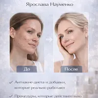 Кожа без прыщей